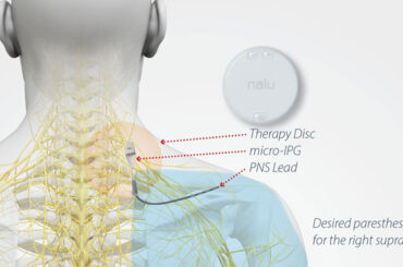 peripheral-nerve-stimulator