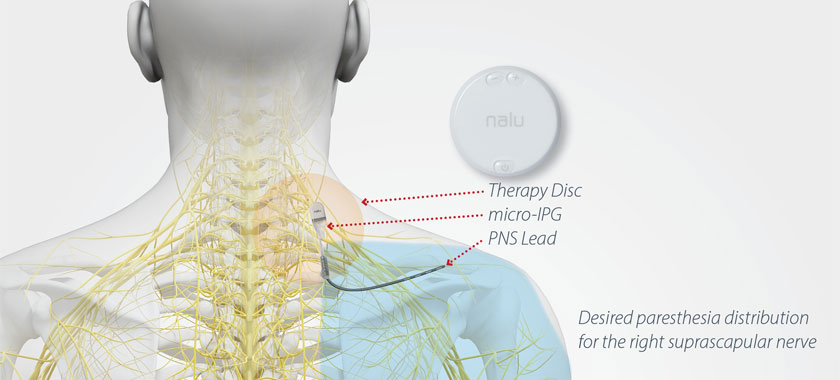 peripheral-nerve-stimulator