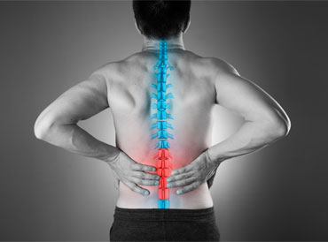 Lumbar Radiculopathy (Sciatica)