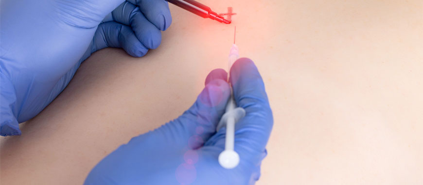 Trigger Point Injections