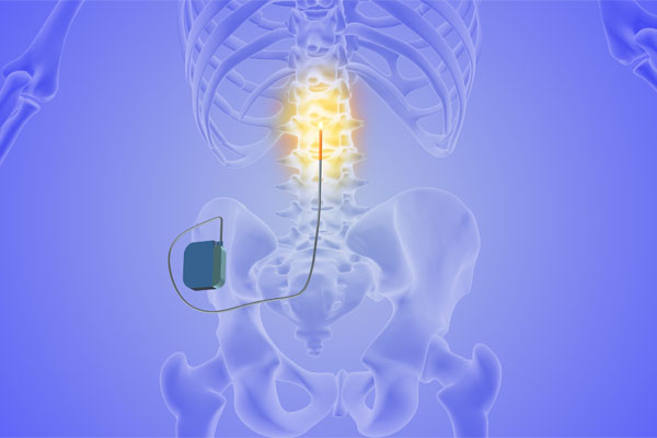 spinal_stimulator_trial