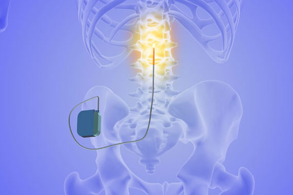 Spinal-Cord-Stimulator-Trial small